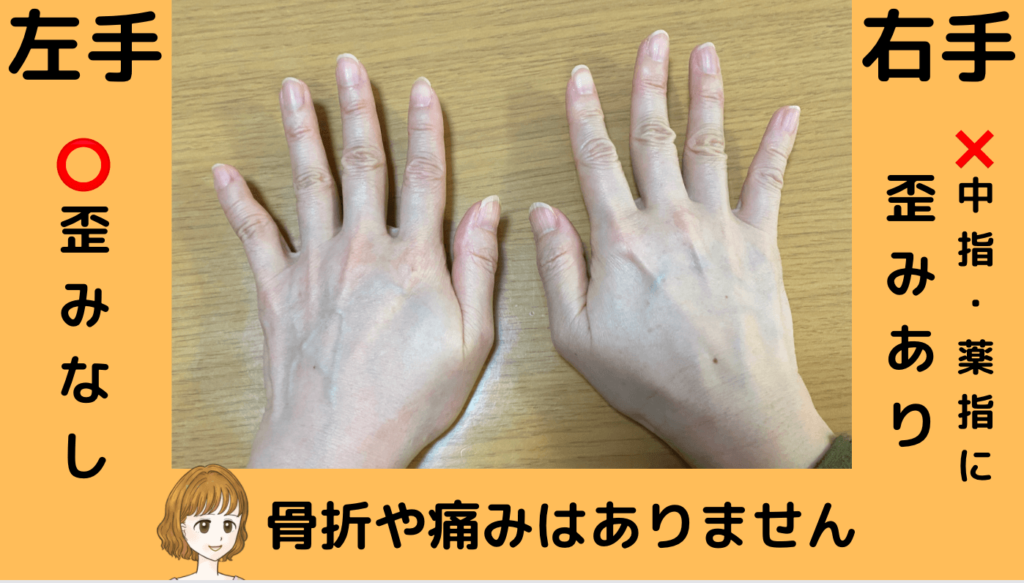 私の両手を実際に撮影した画像で左手は歪みなし、右手は中指と薬指に歪みがあるのが分かるように撮影しました。